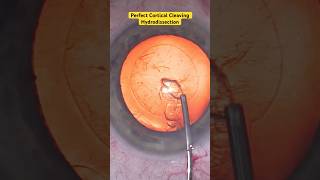 Perfect Cortical Cleaving Hydrodissection  Cataract Surgery [upl. by Dail]