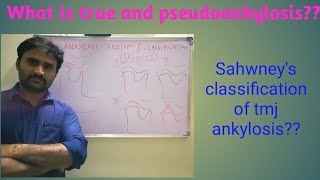 TMJ Ankylosis  anatomy and classification [upl. by Amaerd]