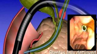 Simulacion Advanix Biliary Stent de Boston Scientific [upl. by Farmann780]