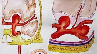 Understanding Brain aneurysm and endovascular coiling [upl. by Cynthy]