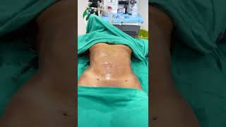 Abdomen Liposuction immediate result shorts [upl. by Ellwood]