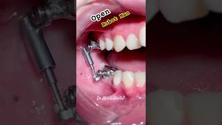 Robot Man  Orthodontics wires  Braces [upl. by Elraet]