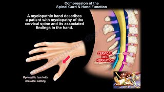 Compression of the Spinal Cord amp Hand Function  Everything You Need To Know  Dr Nabil Ebraheim [upl. by Slaby]