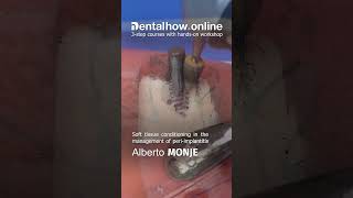 Prepare for periimplantitis Review the theory watch the demonstration and do the workshop at home [upl. by Salmon]