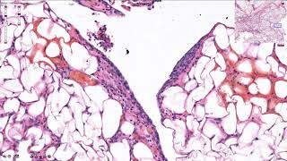 Peritoneal Carcinomatosis  Histopathology [upl. by Mairhpe]