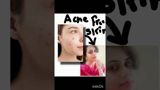 One step to elevate your skin up to crystal clearhomemade acne youtubeshorts shortsviralvideo [upl. by Griswold]