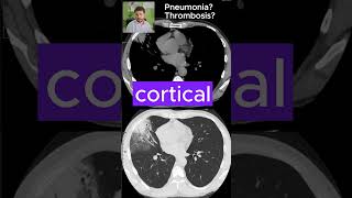 PNEUMONIA or pulmonary THROMBOSIS  CT SCANS Ep 8 medicalimaging ctscan pneumonia thrombosis [upl. by Merry51]