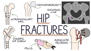 Understanding Hip Fractures and Hip Surgery [upl. by Hameerak]