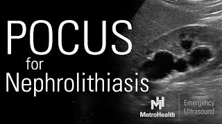 POCUS for Nephrolithiasis [upl. by Beata340]