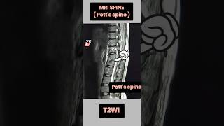 Potts Spine ll Spinal Tuberculosis mri radiology anatomy shorts [upl. by Gan]