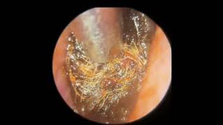 EAR WAX REMOVAL FULL VIDEO Maybe [upl. by Analaj]