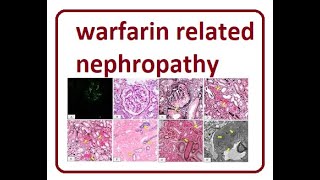 Warfarin Related Nephropathy  2024 [upl. by Artinek]