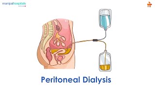 What is Peritoneal dialysis l Manipal Hospitals Bengaluru [upl. by Sommers]