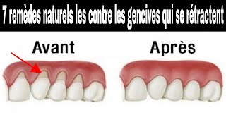 Les 7 remèdes naturels les plus efficaces contre les gencives qui se rétractent [upl. by Eeresed]