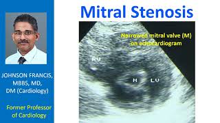 Mitral Stenosis [upl. by Geoff]