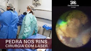 Pedras nos rins  Cirurgia a laser [upl. by Akfir]