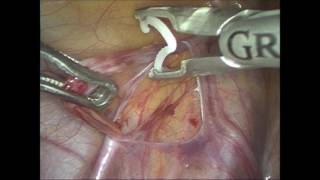 Laparoscopic varicocelectomy using polymer ligating clips [upl. by Hola]