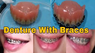 Complete Denture with Braces How you Like that Denture with braces or Pustiso with braces [upl. by Delaney]