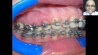 Pegado de Brackets y Tubos en las Tecnicas Individualizadas 2 [upl. by Vrablik688]