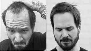 Hairstyles for receding hairlines [upl. by Douty]