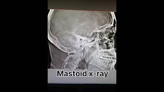 mastoid x ray ear x ray radiology shortvideo [upl. by Einra]