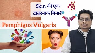 Pemphigus  skin की एक ख़तरनाक बिमारी  चमड़ी और मुँह में छाले और घाव pemphigus oralulcer ulcers [upl. by Rochemont]