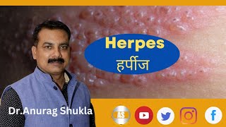 herpes zosterherpes zoster treatmentherpes virusherpes zoster symptoms [upl. by Yrennalf]