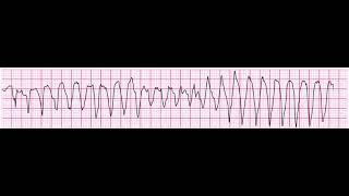 Torsades de Pointes 200bpm polymorphic ventricular tachycardia [upl. by Airitak152]