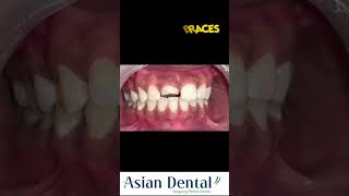 Invisible Braces Treatment in Vijayawada amp Hyderabad  Asian Dental  invisiblebraces happypatient [upl. by Mandell335]