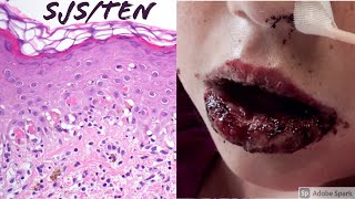 StevensJohnson SyndromeToxic Epidermal Necrolysis SJSTEN Spectrum [upl. by Portwine]