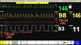 Cardiac Arrest  Patient Monitor [upl. by Reeher]