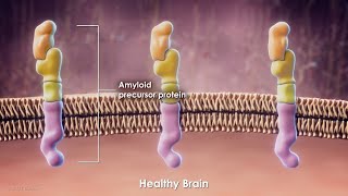 Current Treatments and Research for Alzheimers Disease [upl. by Ntsyrk]