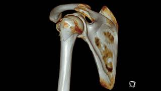 Humerus Greater Tuberosity Fracture [upl. by Mcnalley]