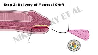 Minimally Invasive Method for Distal Urethral Reconstruction Patient Information [upl. by Brendan917]