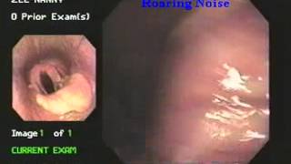 roaring disease laryngeal hemiplegiaby endoscopy [upl. by Nolahs]