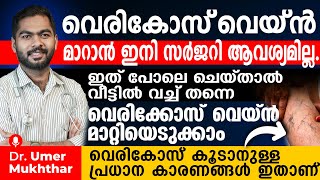 സർജറി ആവശ്യമില്ലാതെ വെരികോസ് വെയ്ൻ ഇങ്ങനെ ചെയ്താൽ വീട്ടിൽ വച്ച് തന്നെ മാറ്റിയെടുക്കാം vericose vein [upl. by Kcirtemed]