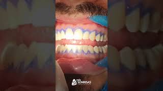 blanqueamiento Dental con peróxido de hidrógeno al 40  boost ultradent [upl. by Naniac]