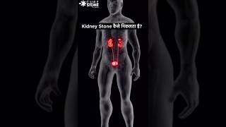 How kidney stones are removed  Retrograde Intrarenal Surgery  RIRS  laser treatment  shorts [upl. by Anaerdna]