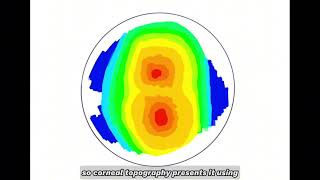 Introduction of Orthokeratology lens [upl. by Brandt]