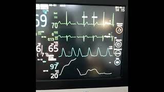 ECG  Todos os Parâmetros da Monitorização [upl. by Eilliw]