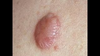 How to Get Rid of a Stubborn Keloid [upl. by Tterab210]