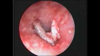 Fruitfly Larva in the Auditory Canal  NEJM [upl. by Ilecara]