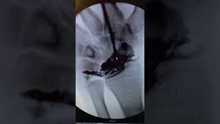 Wrist Arthrogram [upl. by Nigrom]