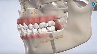 Orthognathic Surgery at North Jersey Oral amp Maxillofacial Surgery Teaneck NJ [upl. by Estey601]