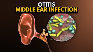 Middle Ear Infection Otitis Media Causes SIgns and Symptoms Diagnosis and Treatment [upl. by Donaugh390]