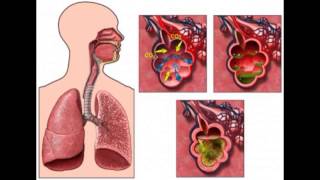 BRONQUITIS CAUSAS SÍNTOMAS Y TRATAMIENTO BRONQUIOLITIS TRATAMIENTO PARA BRONQUITIS NEBULIZACIÓN [upl. by Lopes]