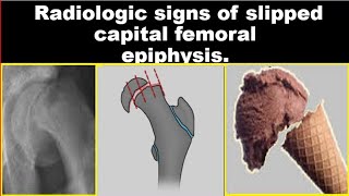 Radiologic signs of Slipped Capital Femoral Epiphysis [upl. by Nahtaneoj]