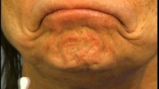 Instructions for Using Botox in the Chin by Dr Elliott of Skinspirations [upl. by Flosser]