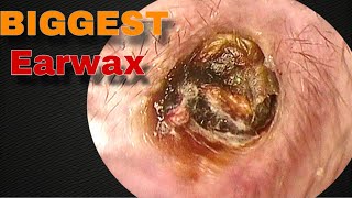 BIGGEST Earwax Difficult Removal EP9  Doctor Anh [upl. by Arihsaj698]