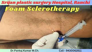 Varicose veins treatment with foam Sclerotherapy Varicose veins treatment for SSC GD medical test [upl. by Aketahs]